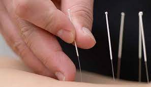 Acupuncture Session